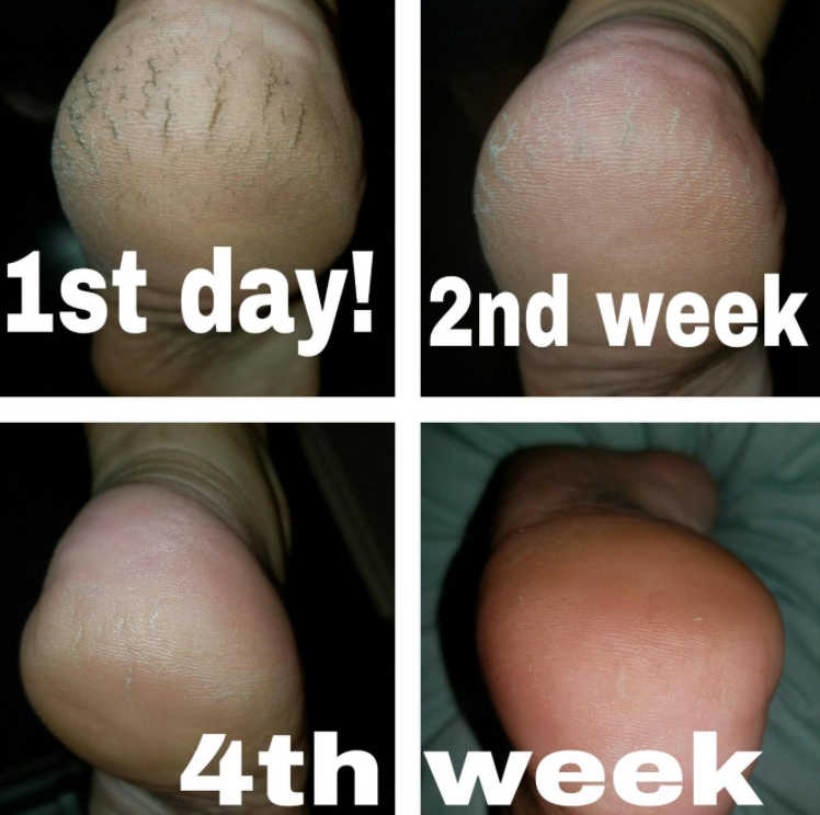 reviewer's cracked heel with drastically improved pics