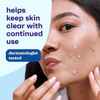 Close-up of a woman's look   with acne, applying a skincare product; substance   highlights benefits for wide   tegument  and dermatologist-tested assurance