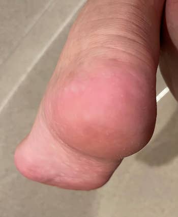 reviewer's photo showing the callus gone after using foot file
