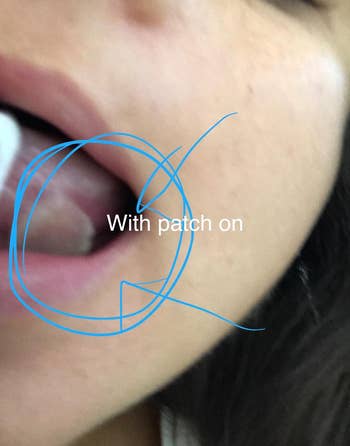 reviewer wearing patch on the sore