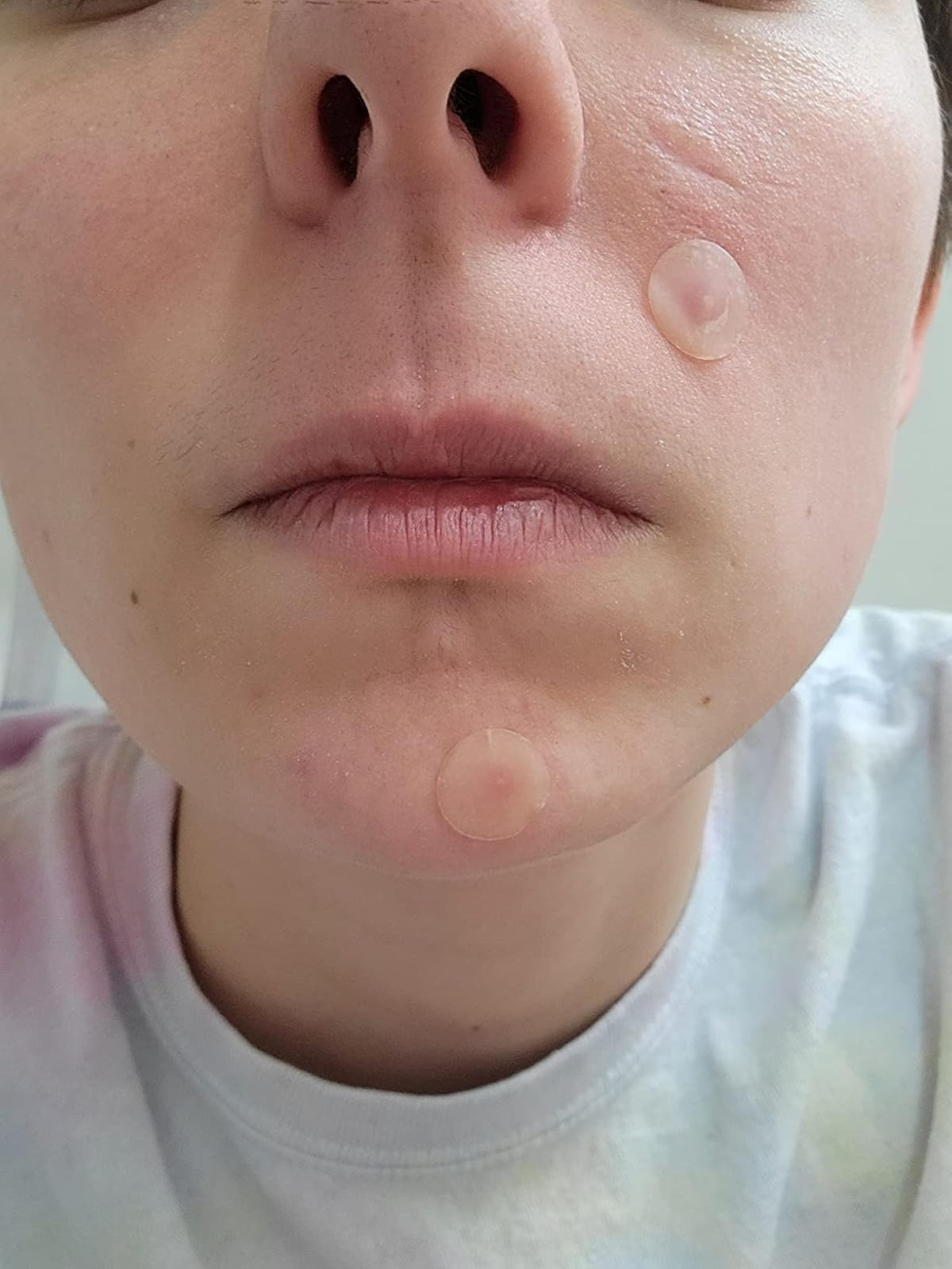 Close-up of a face with acne patches on the chin and cheek
