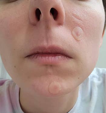 Close-up of a face with acne patches on the chin and cheek