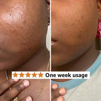 Skincare before-and-after examination  showing improved tegument  texture aft  1  week of merchandise  use, with a five-star rating