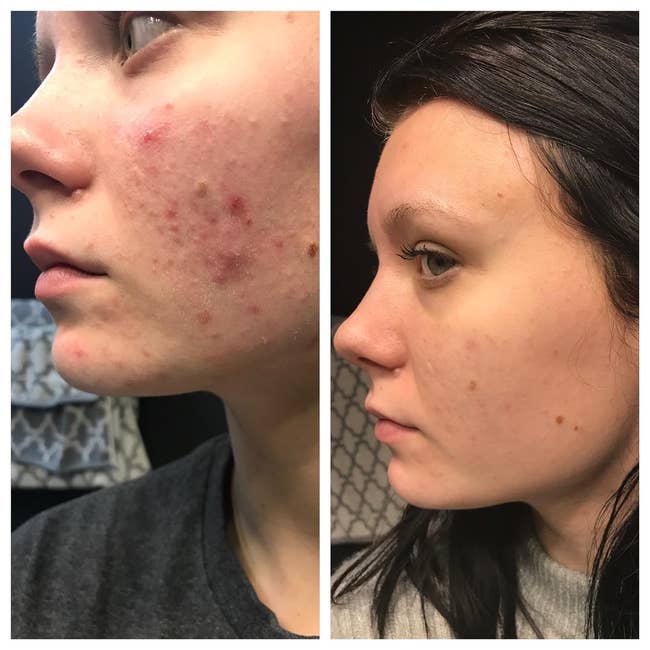 before photo of a reviewer's cheek, which has a lot of active breakouts on it and is quite red next to an after photo of the same reviewer whose cheek is now calm-looking and clear of breakouts