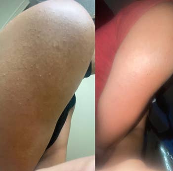 reviewer's arm before and after using exfoliator on shoulder with keratosis pilaris