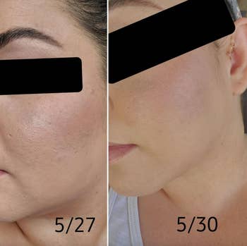 reviewer's before and after three days apart and you can see that the spatula helped improve the texture of their face and made their skin look smoother