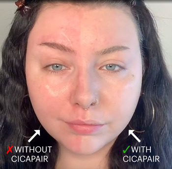 model with one side of face without the treatment, and the other side less red and more even toned with it 