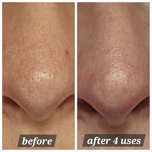 Side-by-side examination  of a chemoreceptor  earlier  and aft  4  uses of a skincare product, showing reduced pores and smoother skin