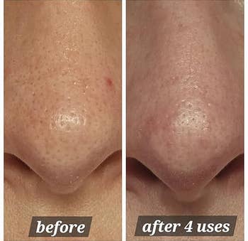Side-by-side examination of a chemoreceptor earlier and aft 4 uses of a skincare product, showing reduced pores and smoother skin