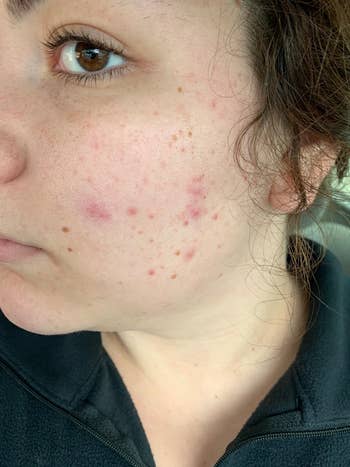 reviewer's before photo showing redness and acne
