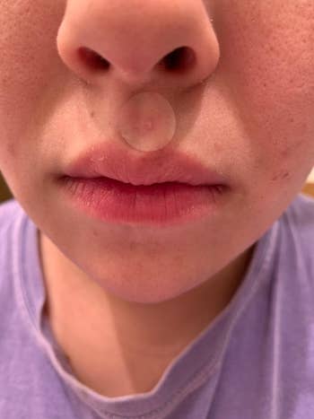 reviewer showing the pimple patch on their upper lip