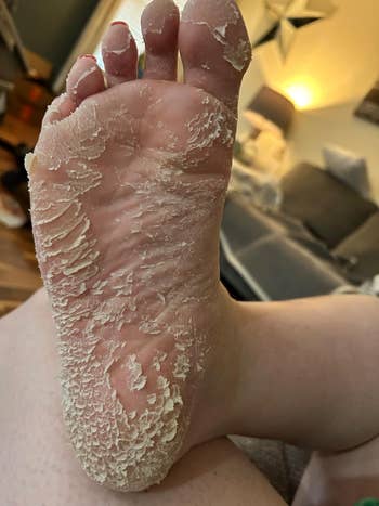 Close-up of a person's cracked and peeling foot, perchance  indicating a request   for moisturizing creams oregon  ft  attraction   products