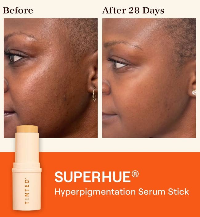 model before and after using Superhue for 28 days with dark spots visibly lightened
