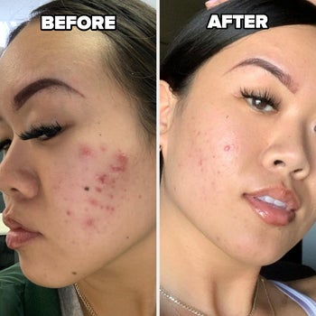 reviewer with cheek breakouts before using the mask and then noticeably clearer cheeks after using the mask consistently