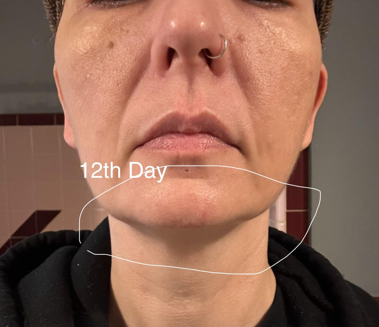 Close-up of a person's face with healing skin; text reads 