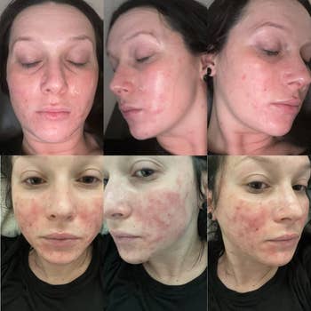 A reviewer's before and after showing irritation from a chemical burn and almost healed skin after