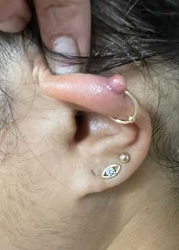 reviewer's ear with a keloid bump on their piercing