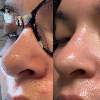 Close-up of a the aforesaid reviewer's chemoreceptor and cheeks, showing a skincare translation with reduced blemishes and smoother skin