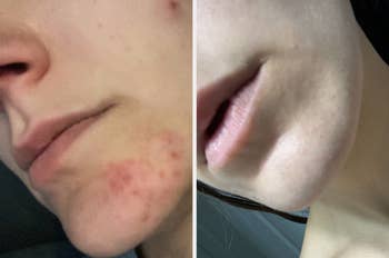 near shows acne connected the jawline, close shows wide tegument transformation