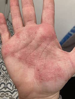 a reviewer with an eczema rash on the palm of their hand 