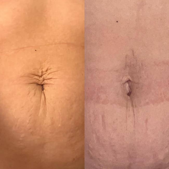 Two close-up images of belly buttons, broadside by side, showing tegument texture and quality differences for comparison