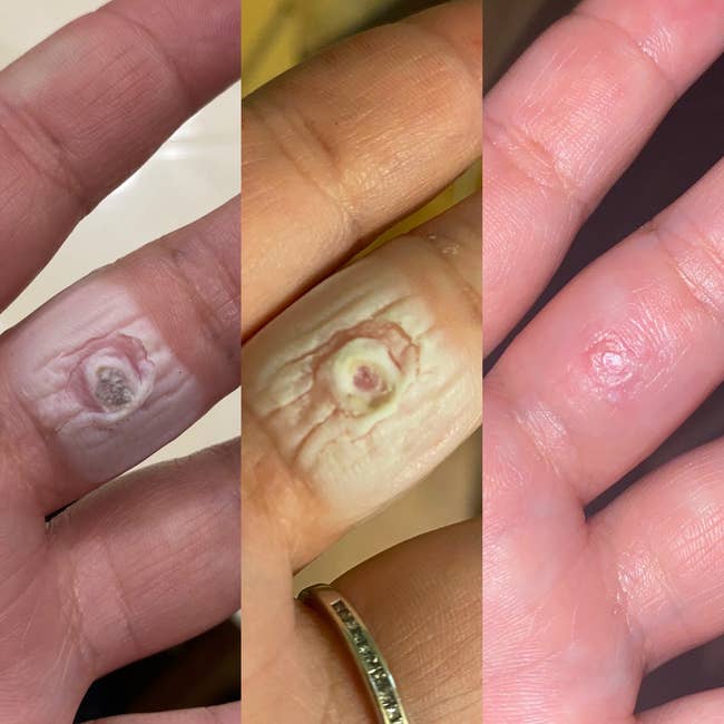 different reviewer's photo series showing the progression of a pad removing a wart on their finger over three days