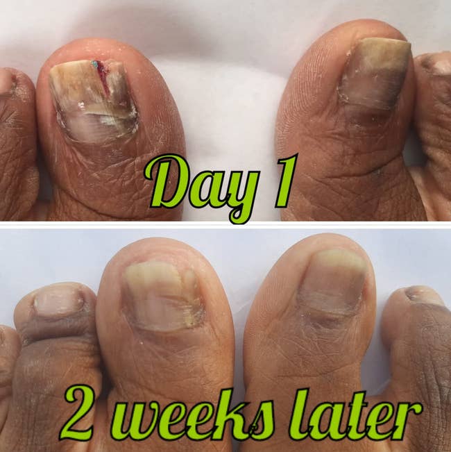 top: Reviewer's big toes with dark and light spots of fungal growth / bottom: The toenails are growing back and looking healthier after 2 weeks of use