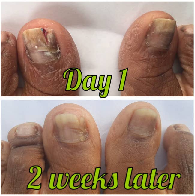 top: Reviewer's big toes with dark and light spots of fungal growth / bottom: The toenails are growing back and looking healthier after 2 weeks of use