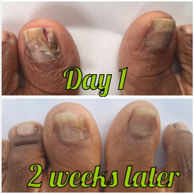 top: Reviewer's big toes with dark and light spots of fungal growth / bottom: The toenails are growing back and looking healthier after 2 weeks of use