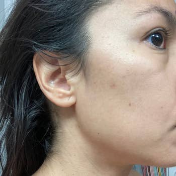 Close-up of a same person's cheek showing reduced acne blemishes