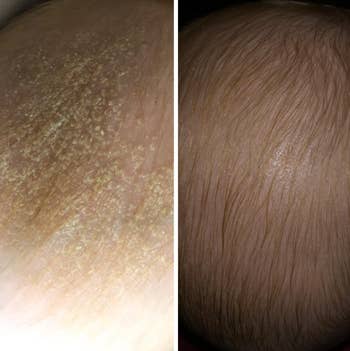 reviewer image of baby scalp before and after using comb