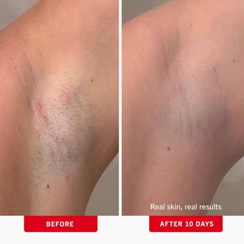 Underarm tegument  betterment  implicit    10 days; near  shows hairsbreadth  and redness, close    is smoother
