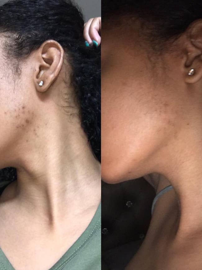 before photo of reviewer with dark skin and acne scars along their jawline and an after photo of the same reviewer with scars that have dramatically faded and are practically invisible