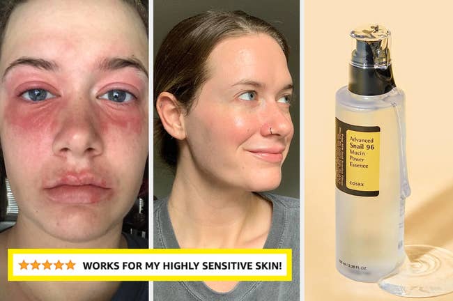 Before and after photos of a person with skin irritation; bottle of snail mucin essence
