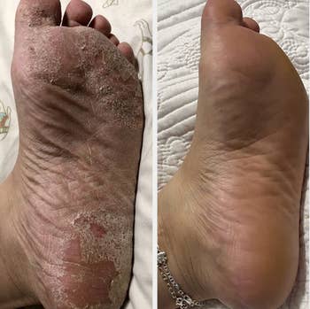 Before of cracked, dry foot and after of the foot with smooth skin 