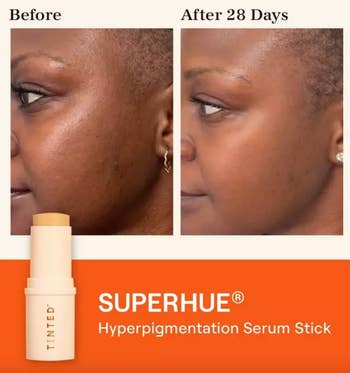 before and after of models skin with hyperpigmentation before and dark spots faded after using serum stick