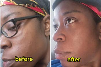 Side-by-side comparison of a woman's face before and after skincare treatment, showing reduced acne and smoother skin