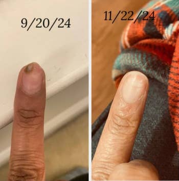 Side-by-side examination  of a digit  connected  9/20/24 with a brownish  spot   and 11/22/24 without the spot, showing healing progress