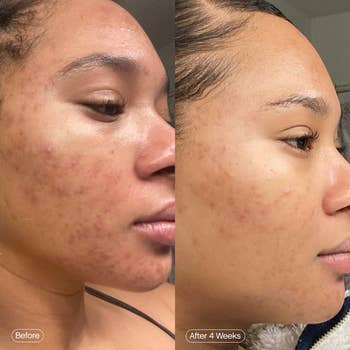 Side-by-side skincare results, left 'Before' with acne, right 'After 4 Weeks' clearer skin