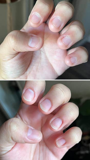 Two close-up images amusement   earlier  and aft  views of nails, demonstrating improved nail wellness  and appearance