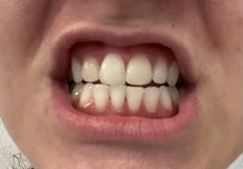 reviewer's teeth after, looking distinctively whiter