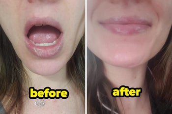 Reviewer with chapped, peeling, dry lips labeled before, and reviewer with smooth hydrated lips labeled after, now smiling