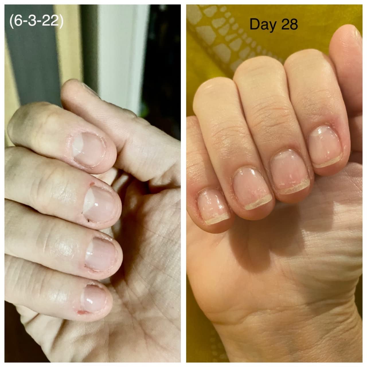 Reviewer pic of their nails before and after they stopped chewing on them
