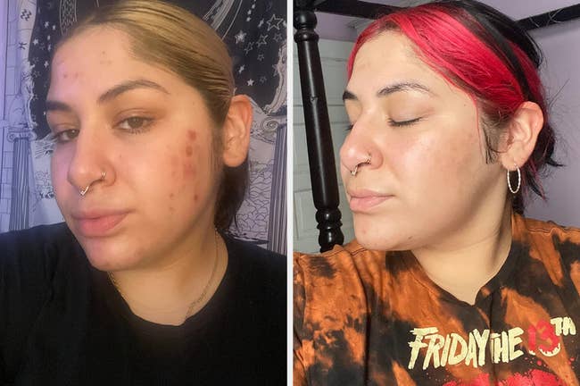 before/after of reviewer's face that looks bright and glowing after using the vitamin c serum - before pic shows skin looking much duller with acne
