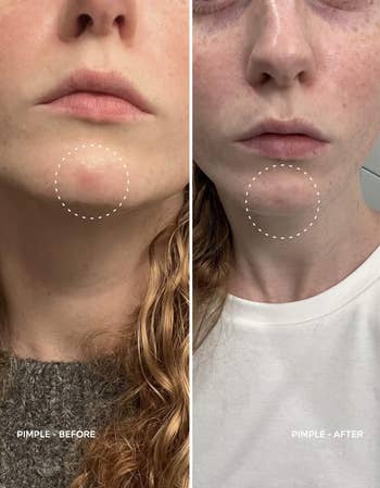 A model with an under-the-skin pimple on their chin labeled before, and after using the spray with the pimple appearing drastically reduced and almost no longer there