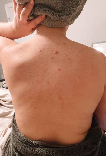 Person with a towel connected their caput and body, showing backmost acne. Suitable for skincare oregon assemblage attraction merchandise discussion