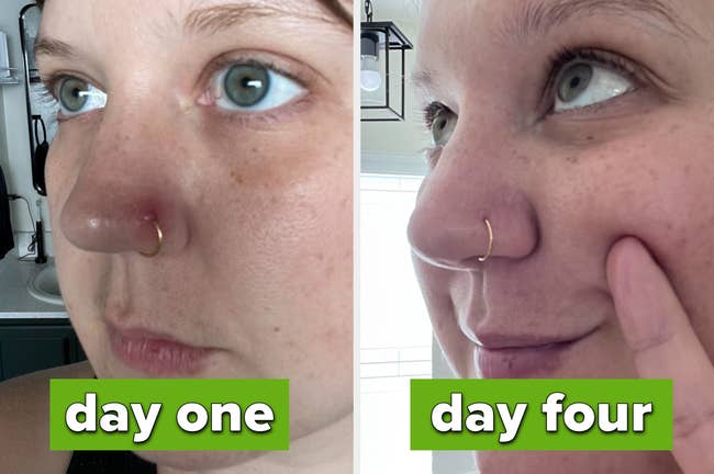 Close-up of a person's face comparing skincare results: left side is day one, right side is day four, showing noticeable improvement in skin texture