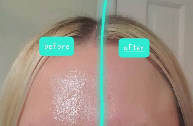 reviewer photo of their forehead, half of which is oily and half of which has been rubbed with the face roller and looks less oily