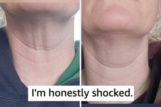 Before and aft  photos of a person's cervix  with disposable   tegument  changes. The substance   reads, 