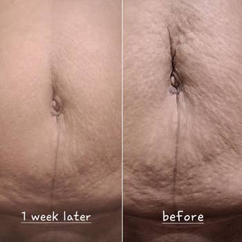 reviewer before and after photo of tummy with loose skin before using the cream and tummy with tight skin after using the cream